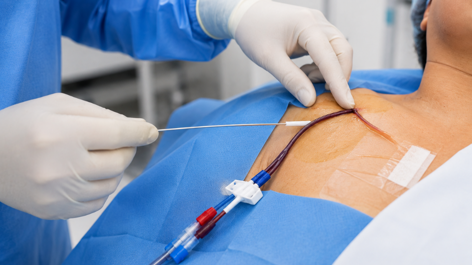 Tunnelled catheter placement